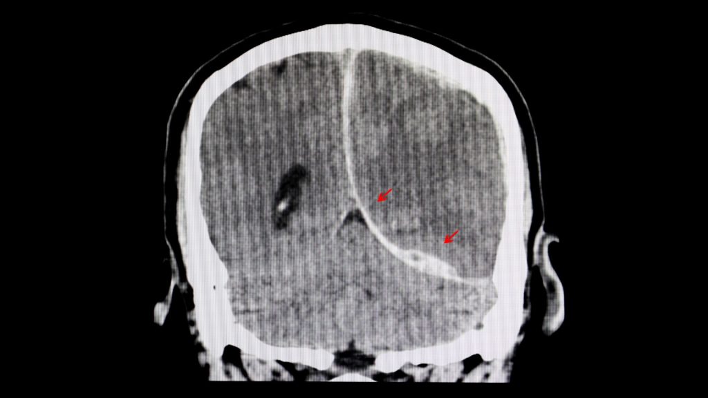 Mount Vernon Traumatic Brain Injury Lawyer